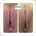 vaginal rejuvenation before and after photos 12