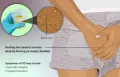 Untreated UTI