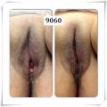 vaginal rejuvenation before and after photos 14