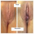pale skin vagina before and after thermiva vaginal rejuvenation