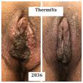 brown skinned vagina before and after thermiva vaginal rejuvenation