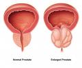 A comparison diagram of the male prostate gland. On the left, a normal-sized prostate with a clear urinary channel. On the right, an enlarged prostate typically caused by benign prostate enlargement (BPH), showing a constricted, irregularly-shaped urinary channel. Labels indicate "Normal Prostate" and "Enlarged Prostate".