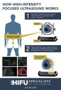 Illustration explaining high intensity focused ultrasound (HIFU) for prostate cancer treatment. Step 1: Probe inserted into rectum, scans prostate to locate tumor. Step 2: High-intensity ultrasound targets and destroys tumor. Includes diagrams of probe and ultrasound focus.