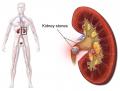 Kidney Stones: different types of kidney stones