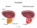 Prostatitis: Inflamed Prostate