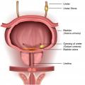illustration of a bladder showing a bladder stone