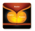 A medical diagram illustrating the male urinary system, highlighting the bladder, prostate gland, and urethra. The bladder is shown at the top, the prostate gland in the middle (indicating benign prostate enlargement), and the urethra as a tube running through the prostate, connecting to the bladder.