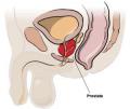 Medical illustration showing a cross-sectional view of male pelvic anatomy, highlighting the prostate gland located below the bladder and surrounding part of the urethra. The prostate is labeled with a line pointing to it. The bladder, urethra, and other organs are also visible. This illustration is essential for understanding treatments like HIFU for prostate cancer.