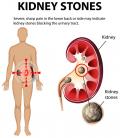 Illustration of kidney stones causing severe pain
