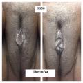 dark skin vagina before and after thermiva vaginal rejuvenation