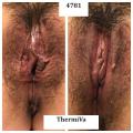 tan vagina before and after thermiva vaginal rejuvenation