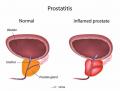 Diagram of normal prostate compared to inflamed prostate which has prostatitis
