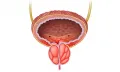 illustration of enlarged prostate