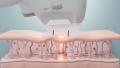 HIFU Ultrasound for prostate cancer treatment