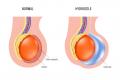 Hydrocele Treatment Options at Comprehensive Urology