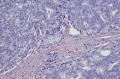 prostate cancer cells