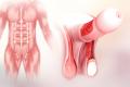 Peyronies-Plaque-Removal
