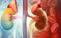 Adrenal tumors in kidneys