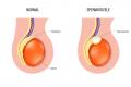 Spermatocele vector. Comparison of normal testicle and spermatocele. Testicular disease. Male reproductive system.