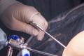 Cauterize-Prostate