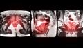 MRI-Imaging-for-Prostate-Cancer