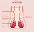 an illustration of testicles with lines showing vasectomy site