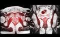 MRI fusion biopsy of prostate scan