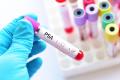 PSA Testing for Prostate Cancer Screening