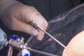 Cauterize-Prostate