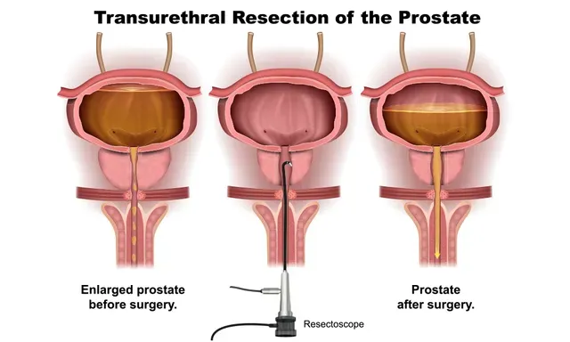an illustration of the TURP process