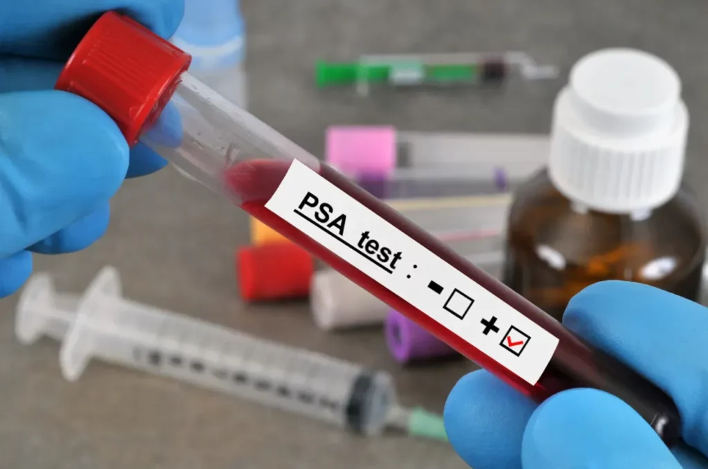 picture of someone holding a small tube filled with blood with the label PSA test