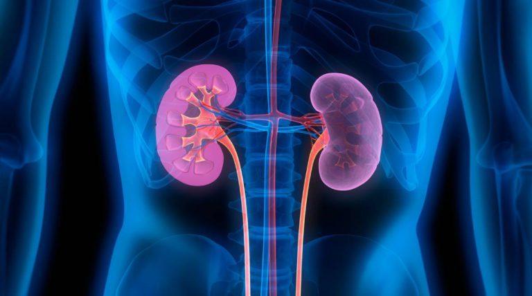 5 Ways to Prevent Kidney Stones