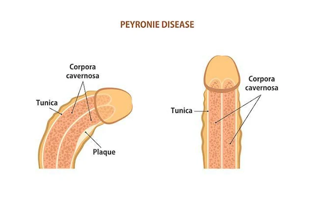 illustration of two penises with peyronie's disease