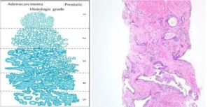Prostate cancer slide showing cancer