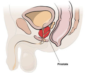 Prostate Cancer Treatment diagram showing prostate location