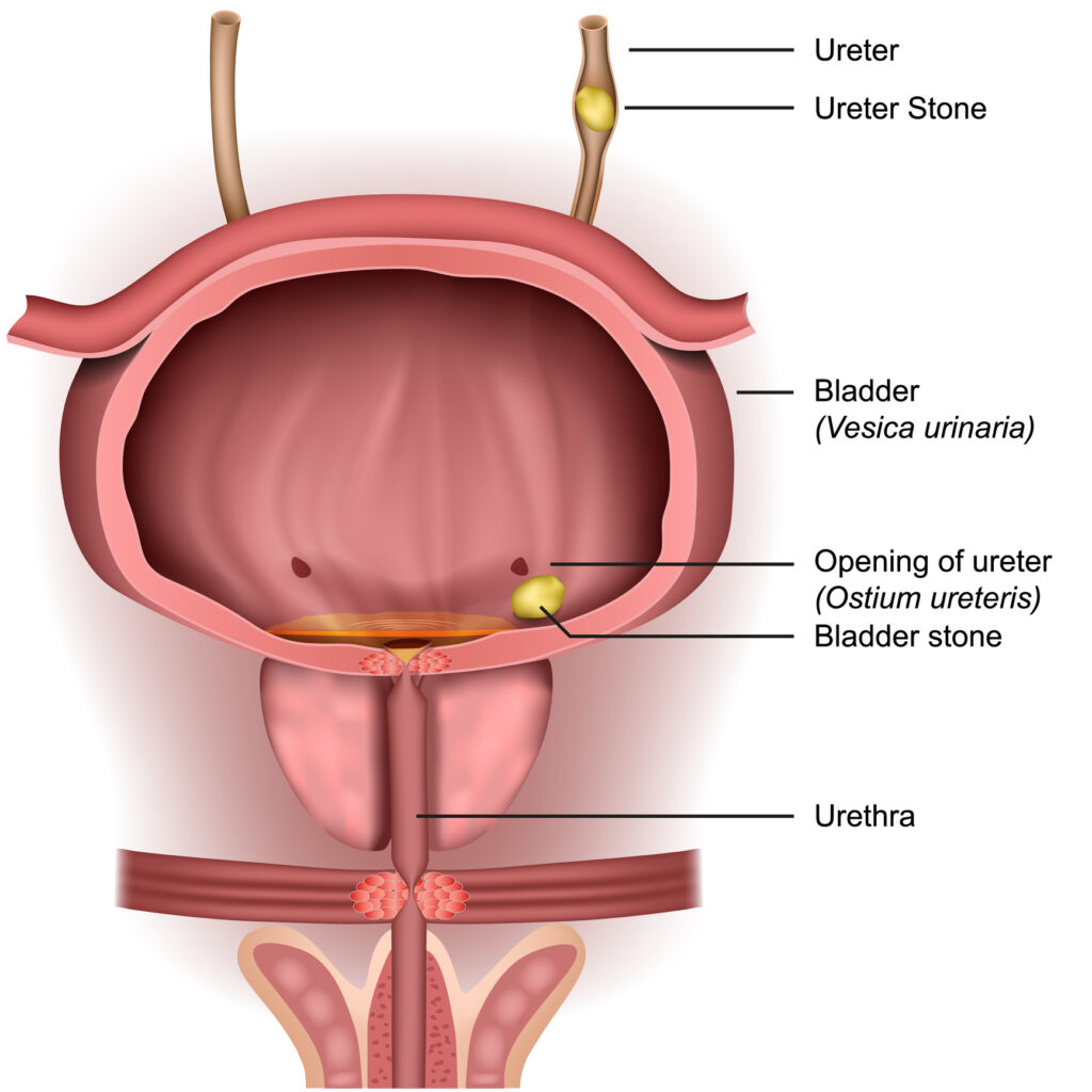 illustration of a bladder showing a bladder stone