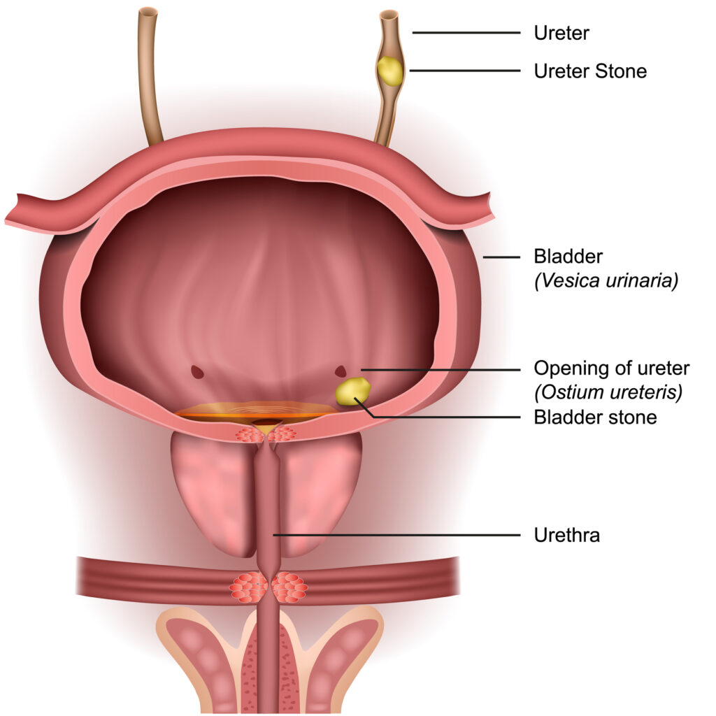 BLADDER STONES Comprehensive Urology