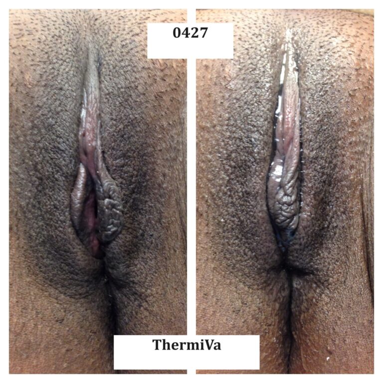 vaginal rejuvenation before and after photos 1
