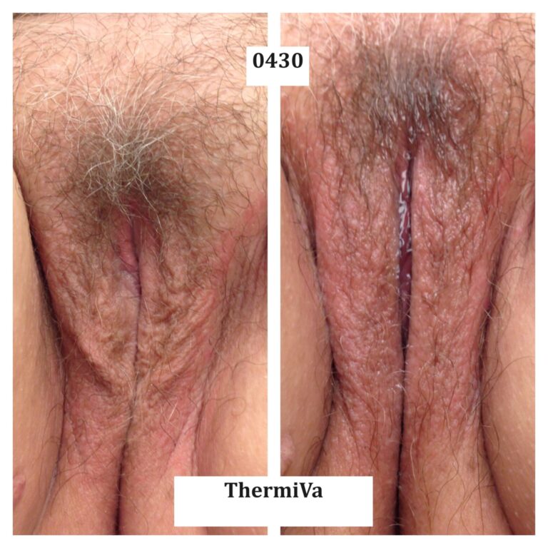 vaginal rejuvenation before and after photos 2