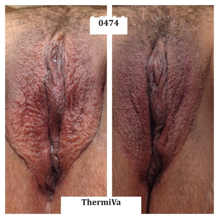 vaginal rejuvenation before and after photos 3