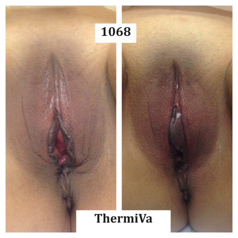 vaginal rejuvenation before and after photos 5