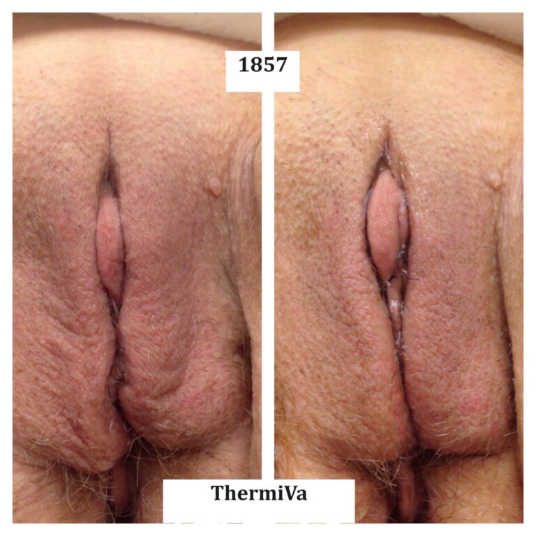 vaginal rejuvenation before and after photos 6
