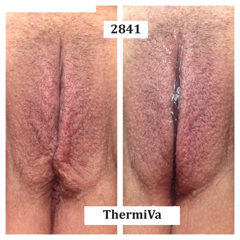 vaginal rejuvenation before and after photos 7