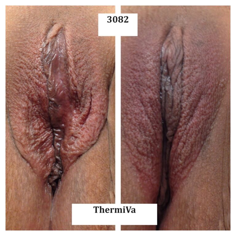vaginal rejuvenation before and after photos 8