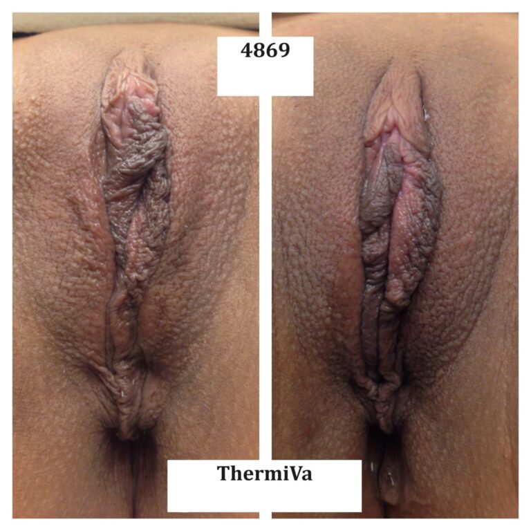 vaginal rejuvenation before and after photos 9