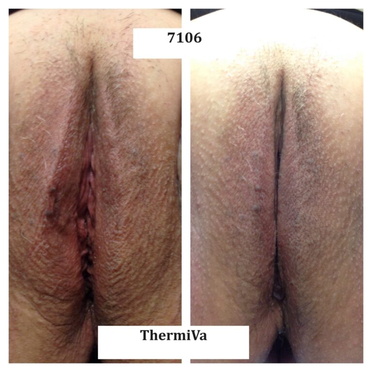 vaginal rejuvenation before and after photos 10
