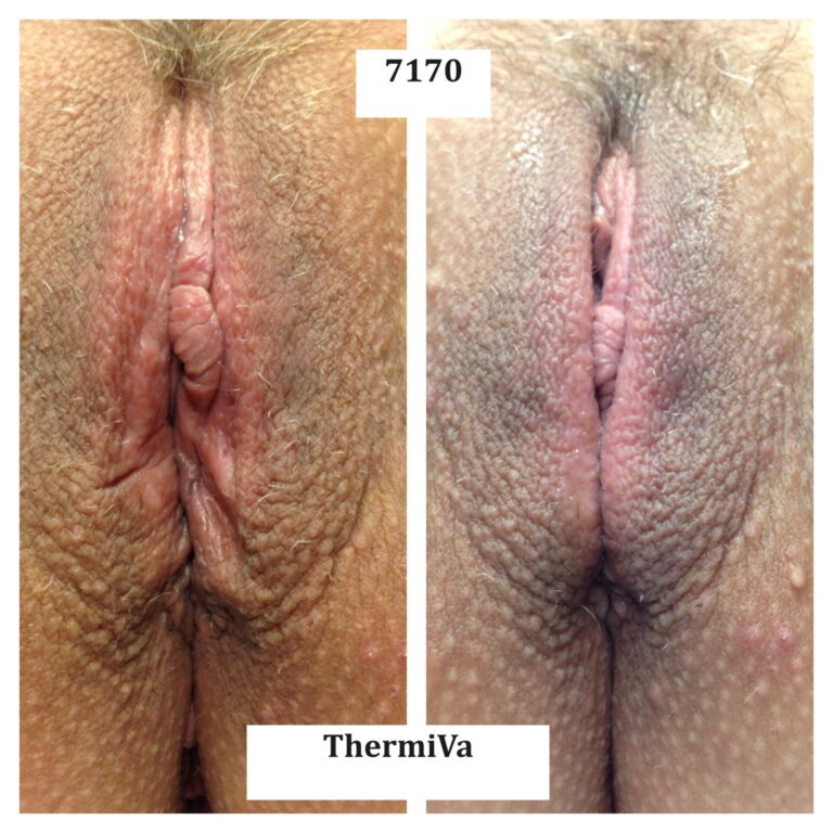 vaginal rejuvenation before and after photos 11